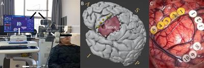 Preoperative individual-target transcranial magnetic stimulation demonstrates an effect comparable to intraoperative direct electrical stimulation in language-eloquent glioma mapping and improves postsurgical outcome: A retrospective fiber-tracking and electromagnetic simulation study